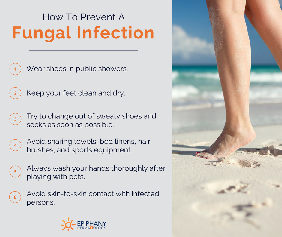 How_to_prevent_common_fungal_infections | Epiphany Dermatology How_to_prevent_common_fungal_infections | Epiphany Dermatology